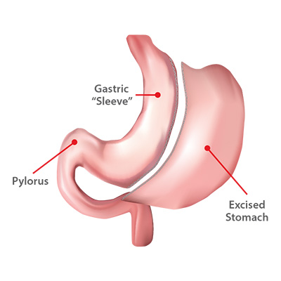 Vertical Sleeve Gastrectomy